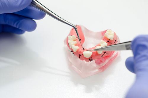 stitches in model denture